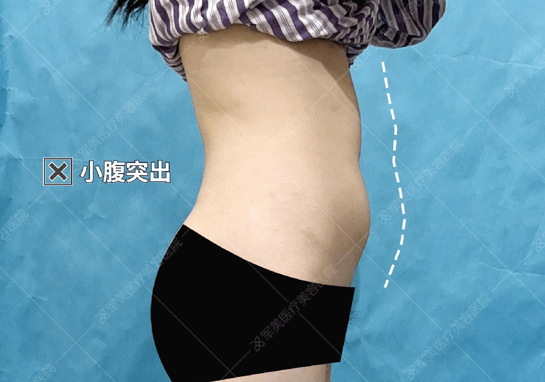 王世虎腰腹吸脂