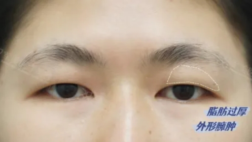 肿泡眼可以割双眼皮吗