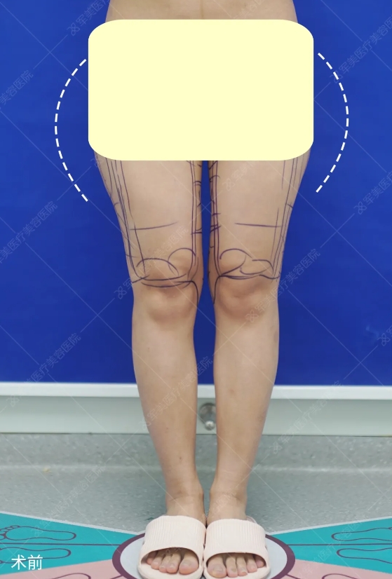 梨形身材怎么减肥最有效