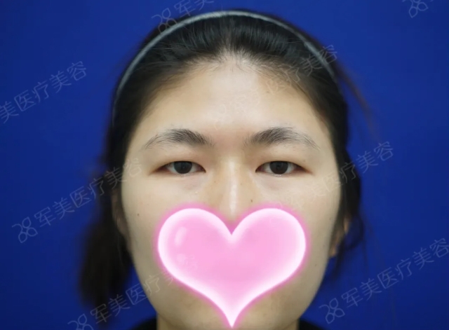 肿泡眼可以割双眼皮吗