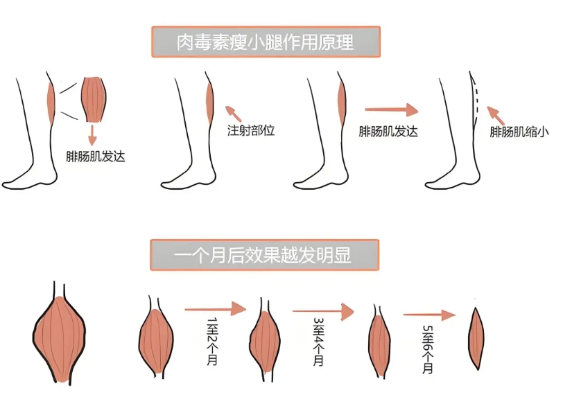 注射瘦小腿案例