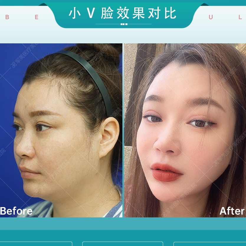法令纹一现，显老10岁！法令纹怎么改善？