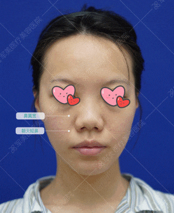 鼻子整形整容