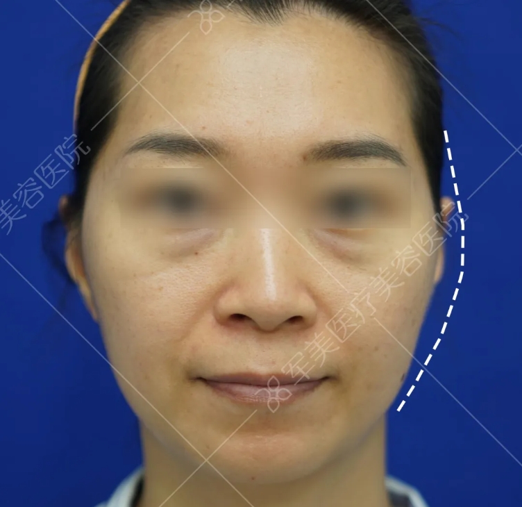 脂肪填充面部好不好
