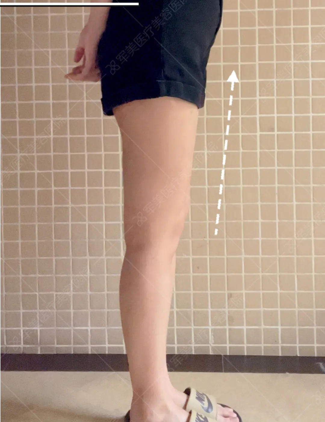 广州大腿吸脂最好的医院