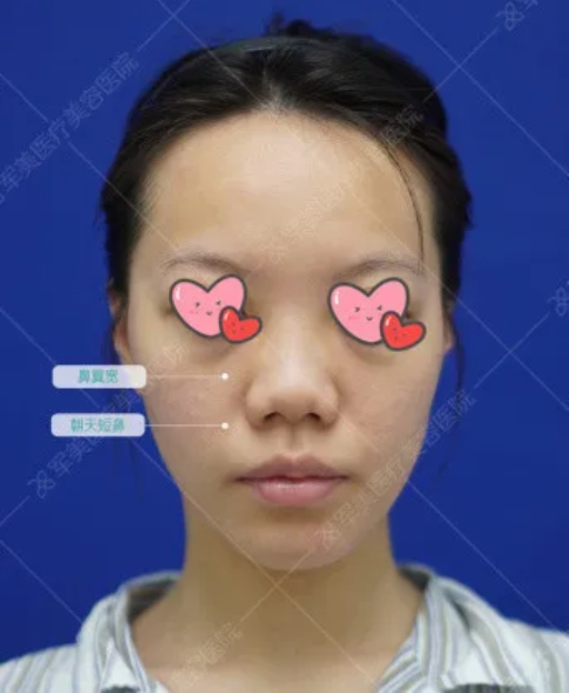 鼻子整形整容