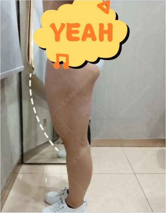 王世虎吸脂案例