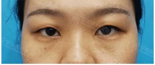 广州双眼皮手术哪里做的最好的医院