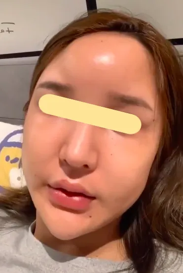 馒化脸是怎么形成的