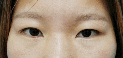 广州双眼皮手术哪里做的最好的医院