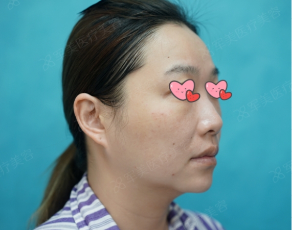 耳软骨隆鼻图片效果