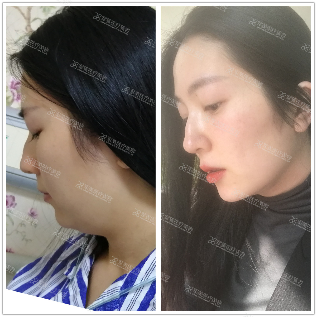 瘦脸最快最有效的方法是什么？快速瘦脸秘籍公开