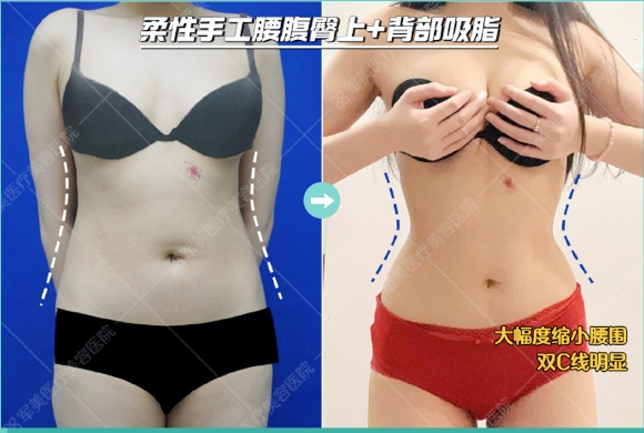 王世虎腰腹吸脂案例
