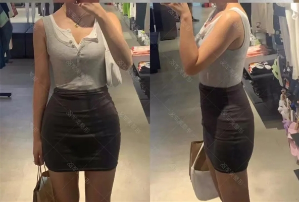 王世虎腰腹吸脂案例