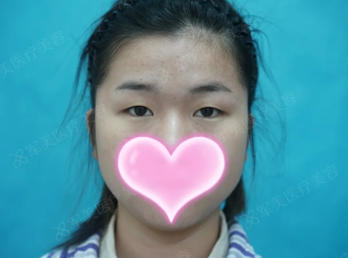 肿泡眼怎么消除