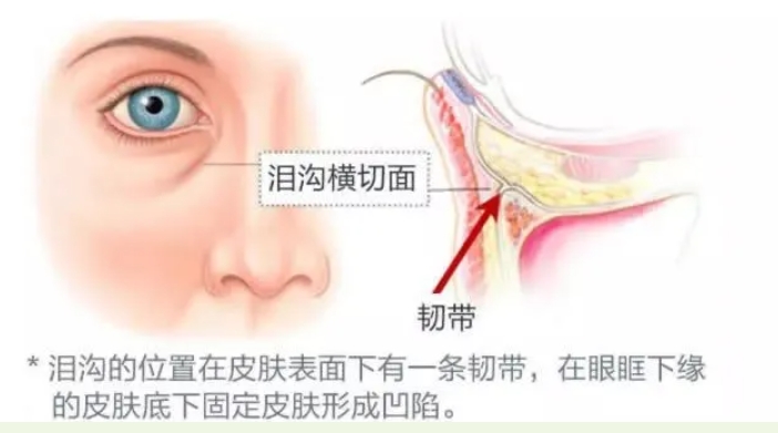 泪沟改善方法