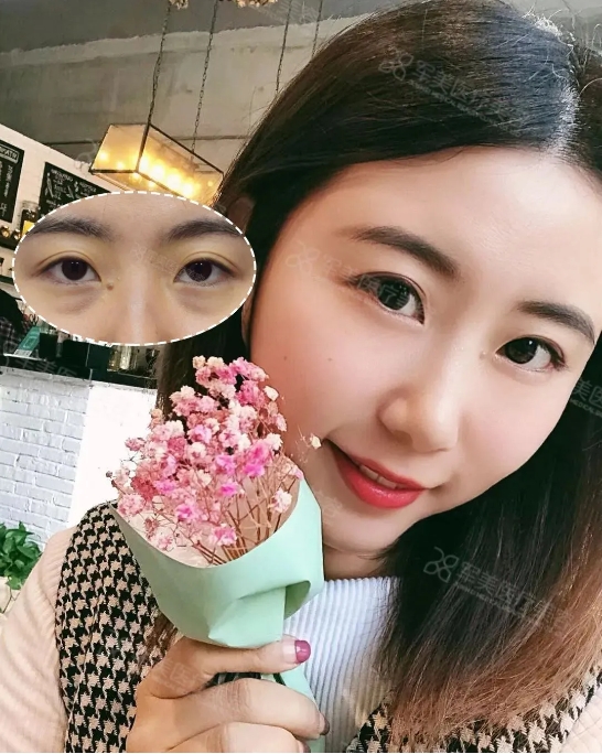 眼袋去除最快最有效的方法