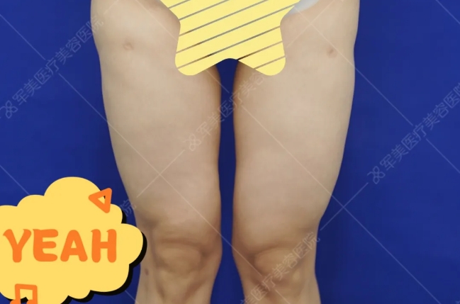 吸脂修复哪里最好
