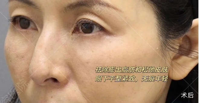 泪沟凹陷填充成功案例