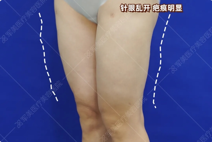 王世虎吸脂修复案例