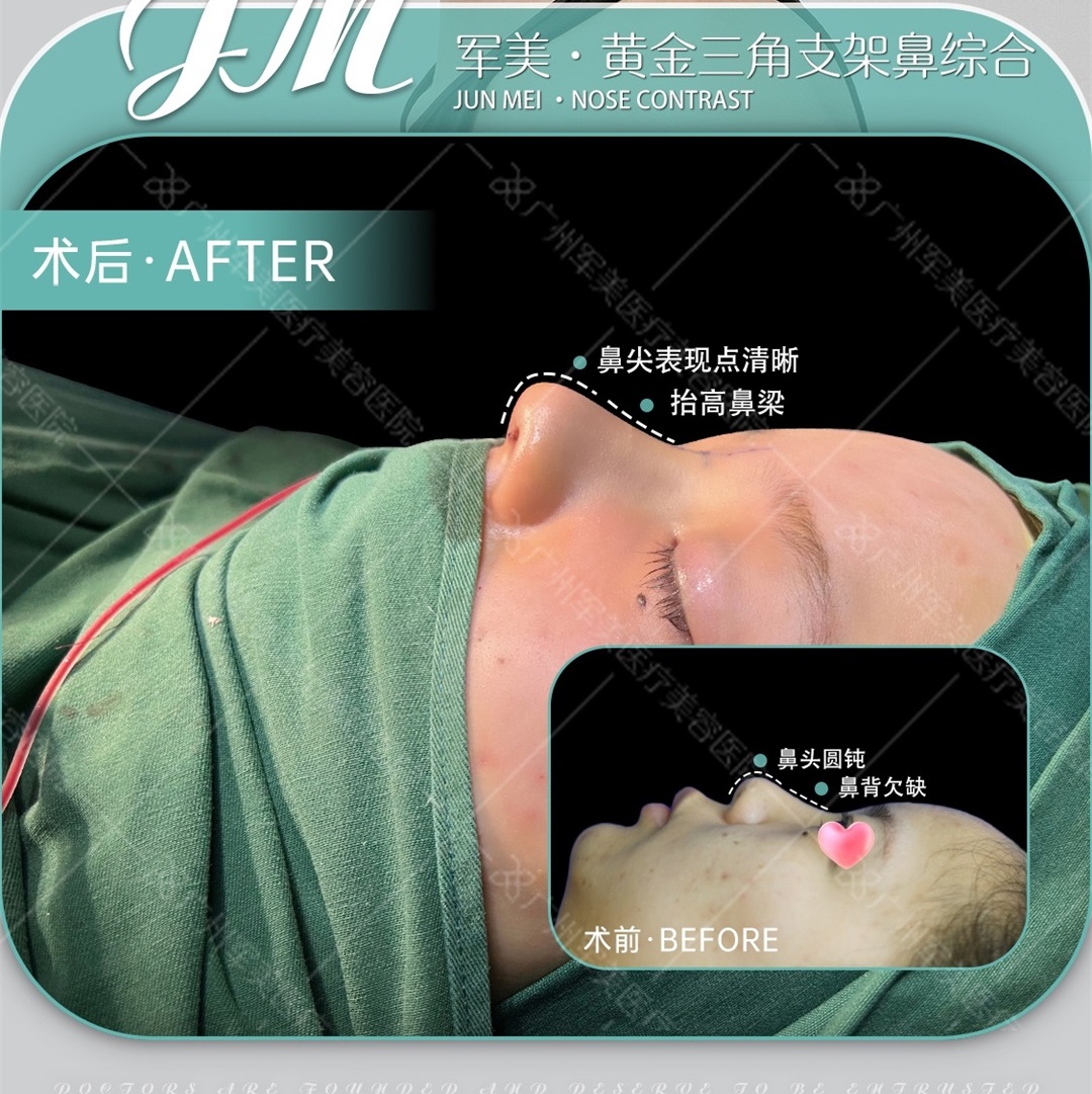 鼻综合整形价格一般多少钱？避开“低价陷阱”的避坑指南