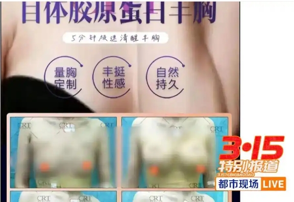 花239万自体丰胸检出黄牛驼鹿DNA