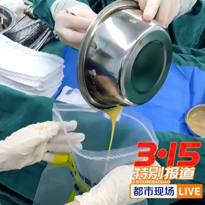 天价自体丰胸竟检出动物DNA？239万整形黑幕曝光引行业震动