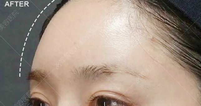 面部脂肪填充哪里好