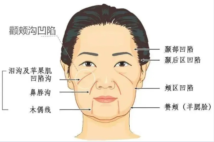 脂肪填充面部多久定型了