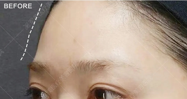 面部脂肪填充哪里好