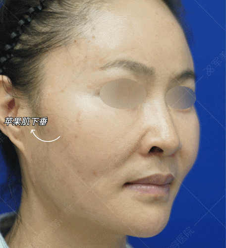苹果肌下垂提升的最好方法