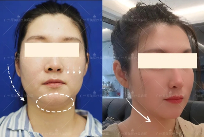 王世虎面部吸脂案例