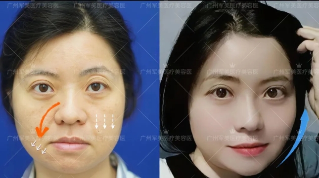 王世虎面部抗衰提升案例