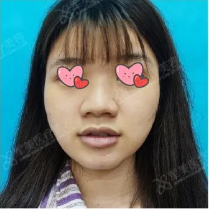 鼻头肥大怎么改善