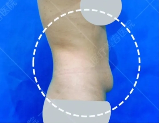 腰腹环吸案例