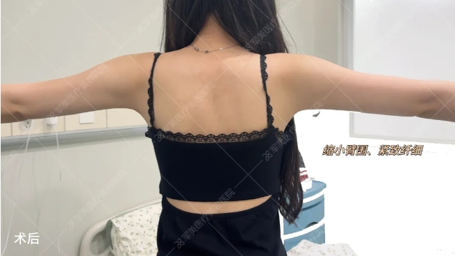 王世虎手臂吸脂案例