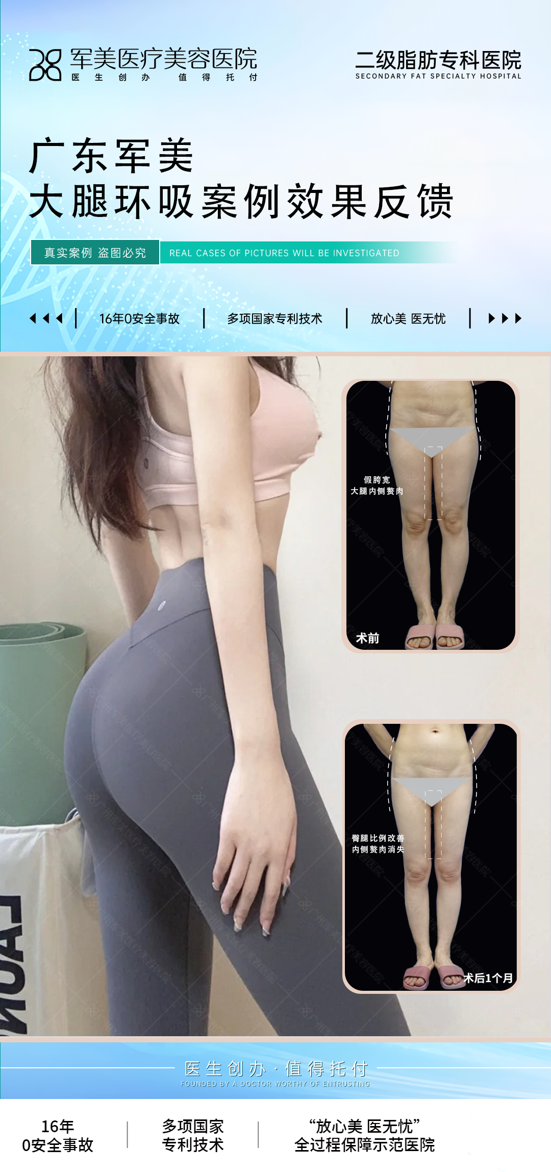 大腿吸脂手术效果能维持多久