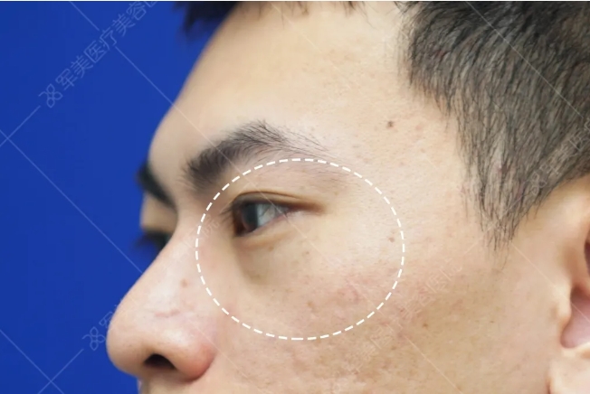 黑眼圈怎么消除最快最有效