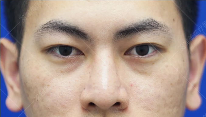 黑眼圈怎么消除最快最有效