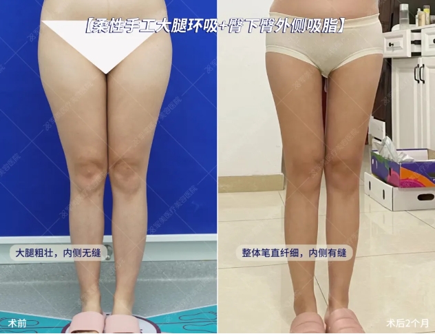 王世虎大腿吸脂案例