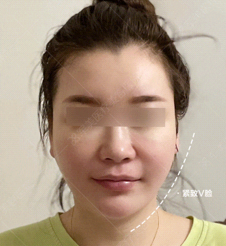 军美赫本少女线案例