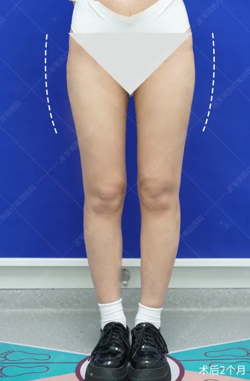 王世虎大腿吸脂案例