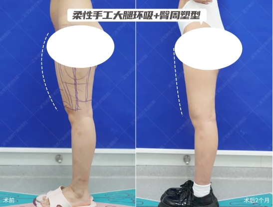 王世虎大腿吸脂案例