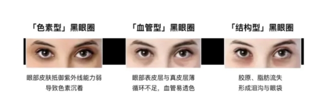 黑眼圈怎么去除案例