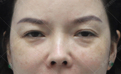 黑眼圈怎么去除案例