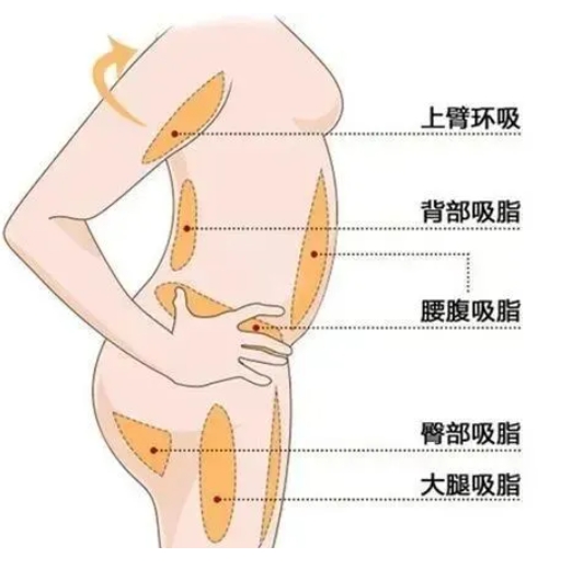 常见的吸脂部位示图