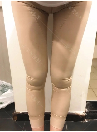 大腿吸脂前后效果图片