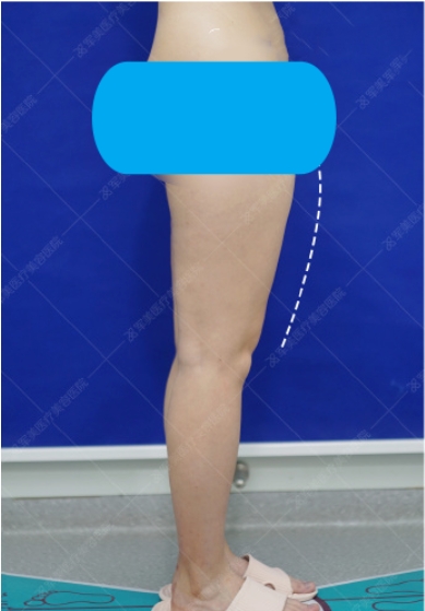 大腿吸脂前后效果图片