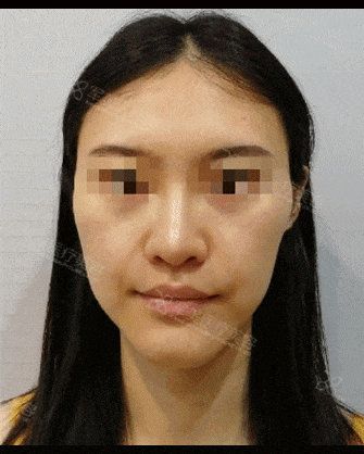自体脂肪填充面部抗衰