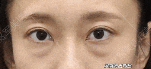 眼袋抗衰老